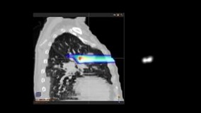 Advantages of Proton Therapy - Willis Knighton Cancer Center