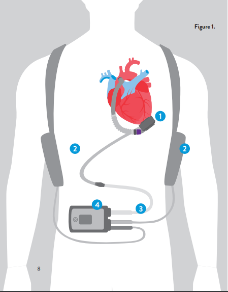 LVAD