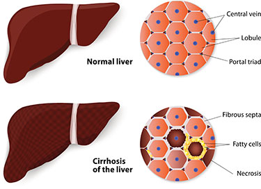 liver-transplant Liver Transplant